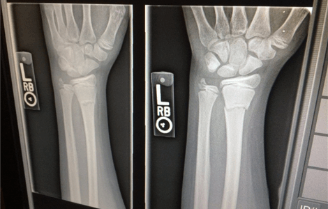 Home doctor in Costa del Sol for broken bone diagnosis and treatment