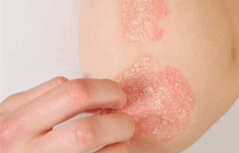 Home Doctor for Skin Infections in Sotogrande